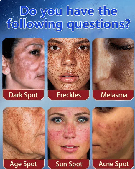 Bikenda™️ Blemish Removing Beauty Cream 16 ed461f5a0ff479d1f0a5fe21029fbe33 38d0fb44 caf9 40c0 a732 eed82d9731c6